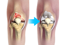 Complex Knee Replacement