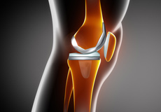 Correction of a Painful Knee Replacement
