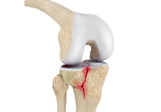Knee Fracture Care