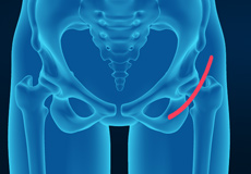 Outpatient and Rapid Recovery Hip Replacement